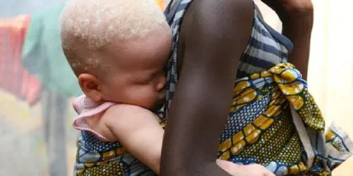 African albino girl